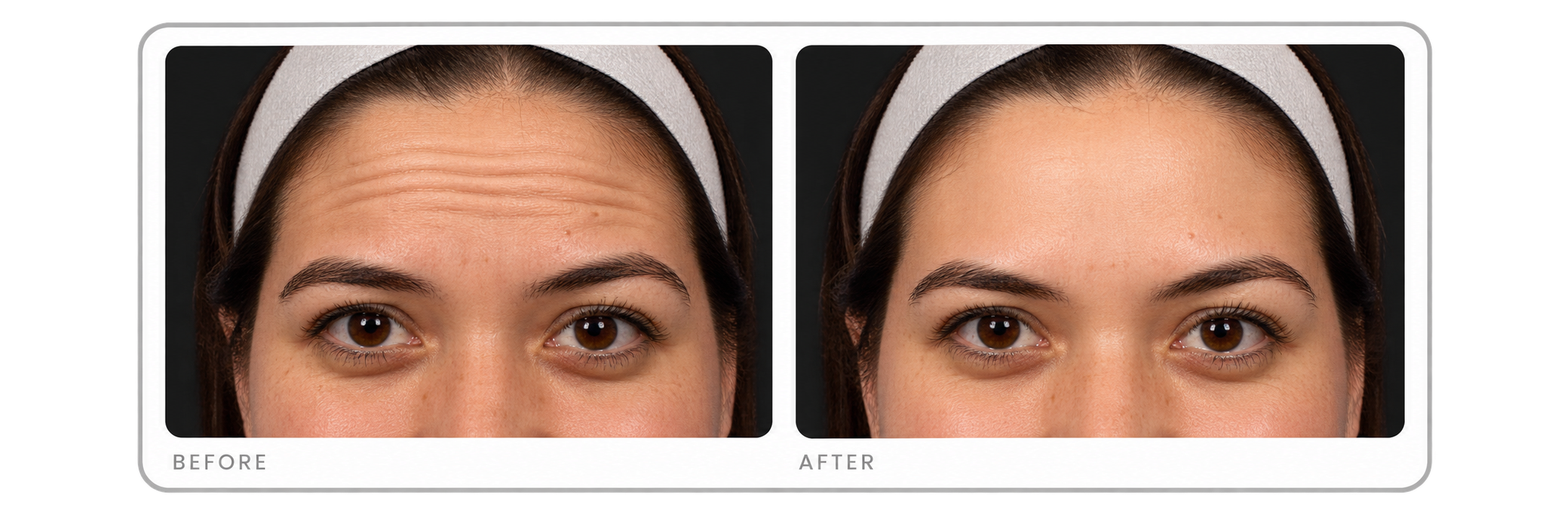 Before and After Forehead Comparison