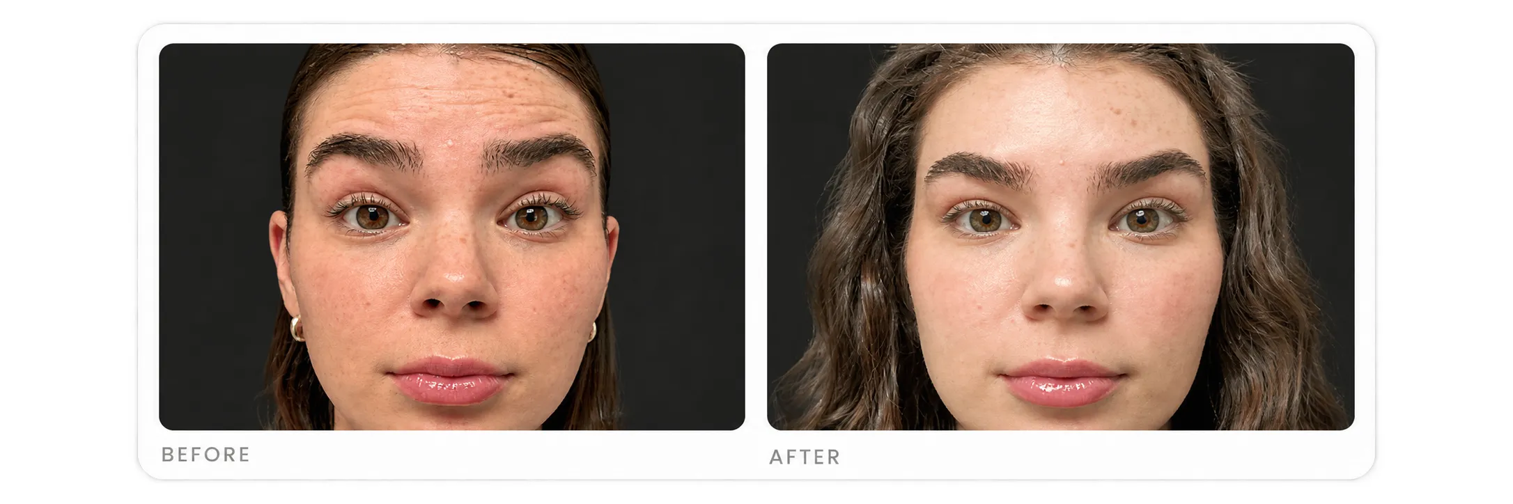 Botox 1